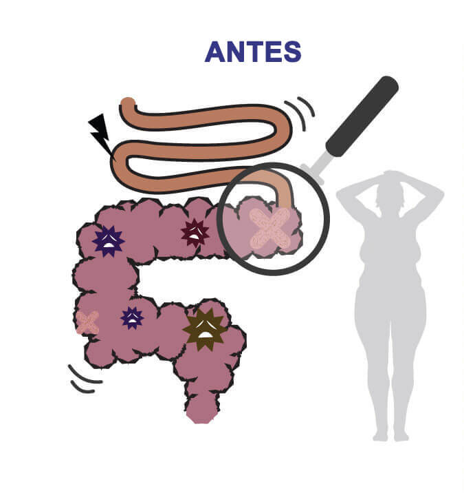 O intestino está cheio de depósitos, incapaz de queimar gordura. Metabolismo ruim. Intestino limpo com motilidade saudável. Metabolismo saudável e queima de gordura rápida.